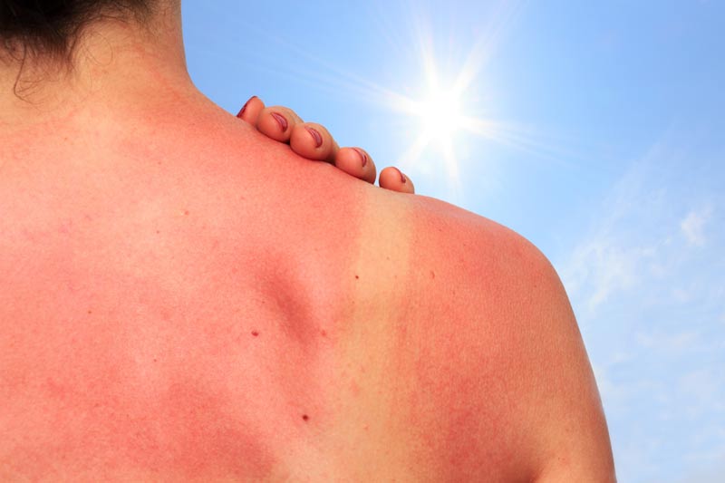 Recomendaciones para cuidar la piel en épocas de altas temperaturas